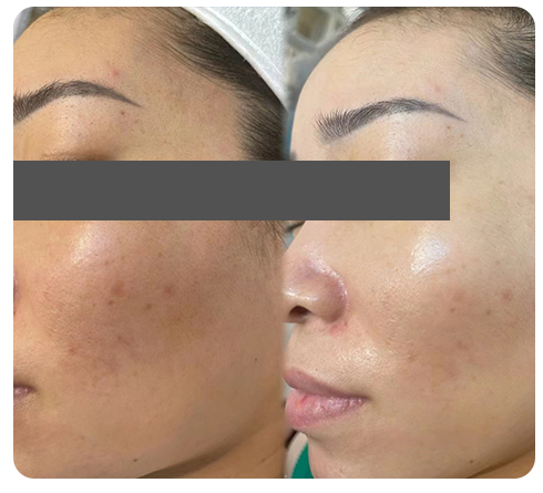 real skin results after exosomes microneedling
