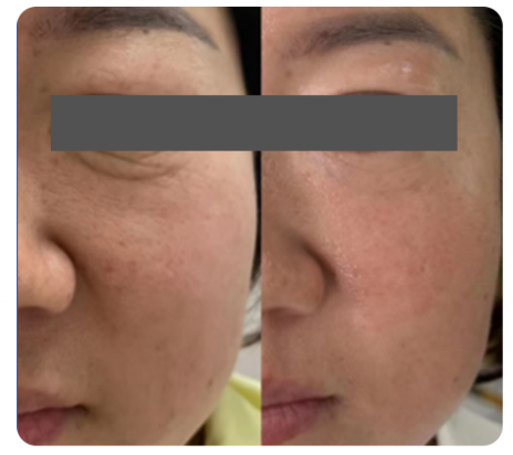Exosome Injection Before & After&nbsp;