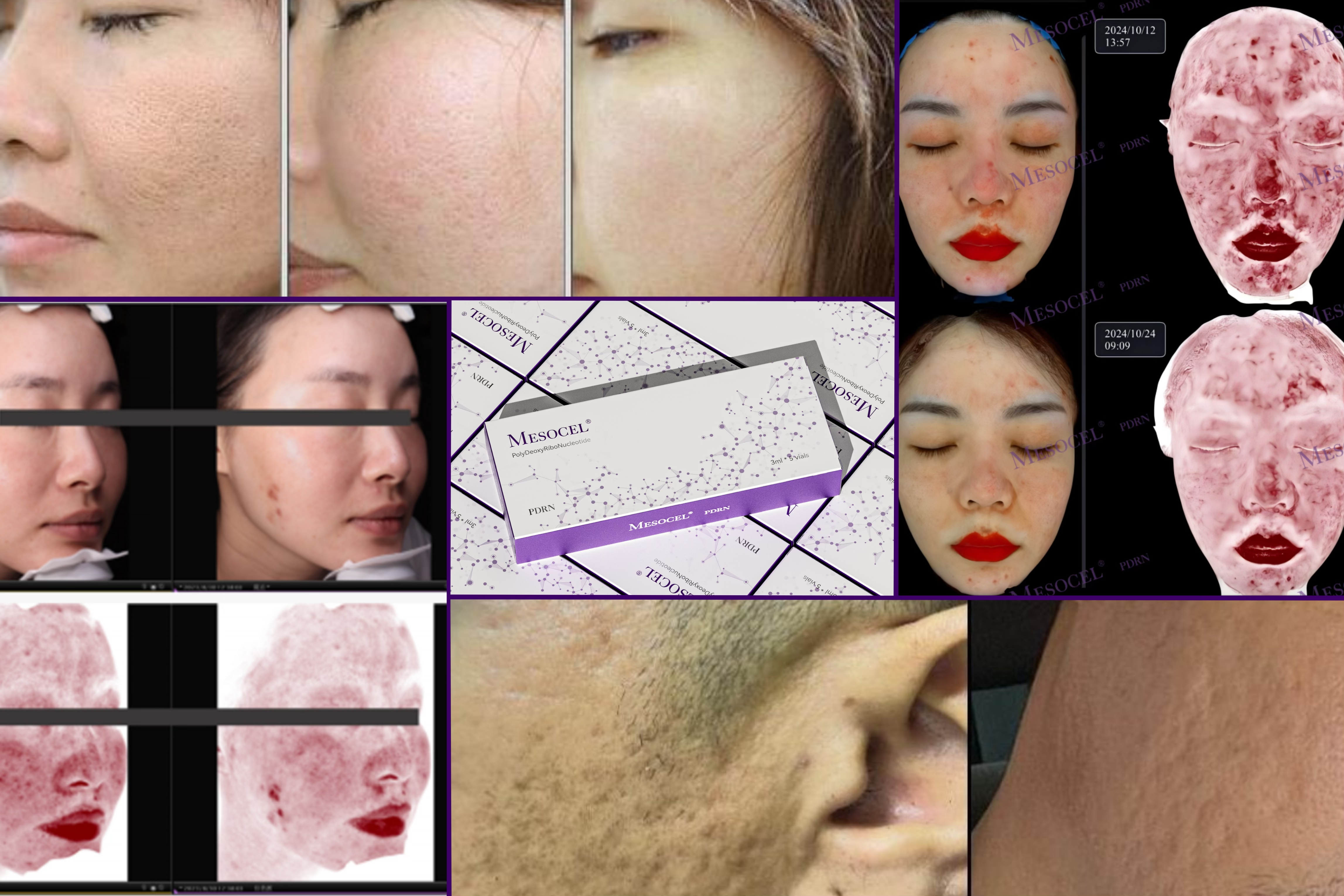 mesocel pdrn injection review