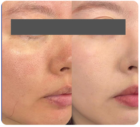 Exosome Injection Before & After&nbsp;