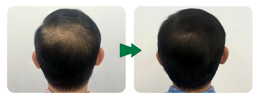 EXOBLOOM&reg; Scalp Care