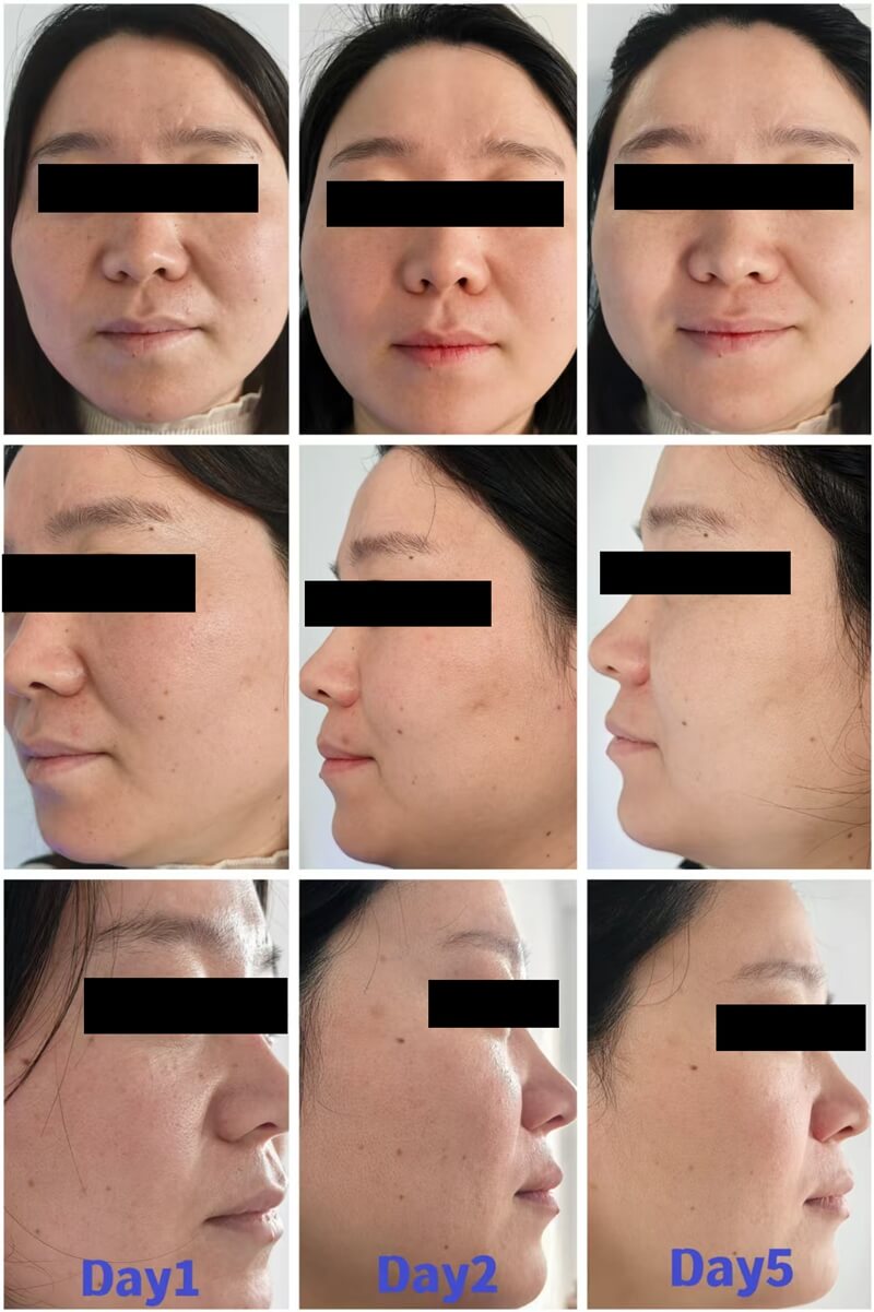 Exosome products Before and After