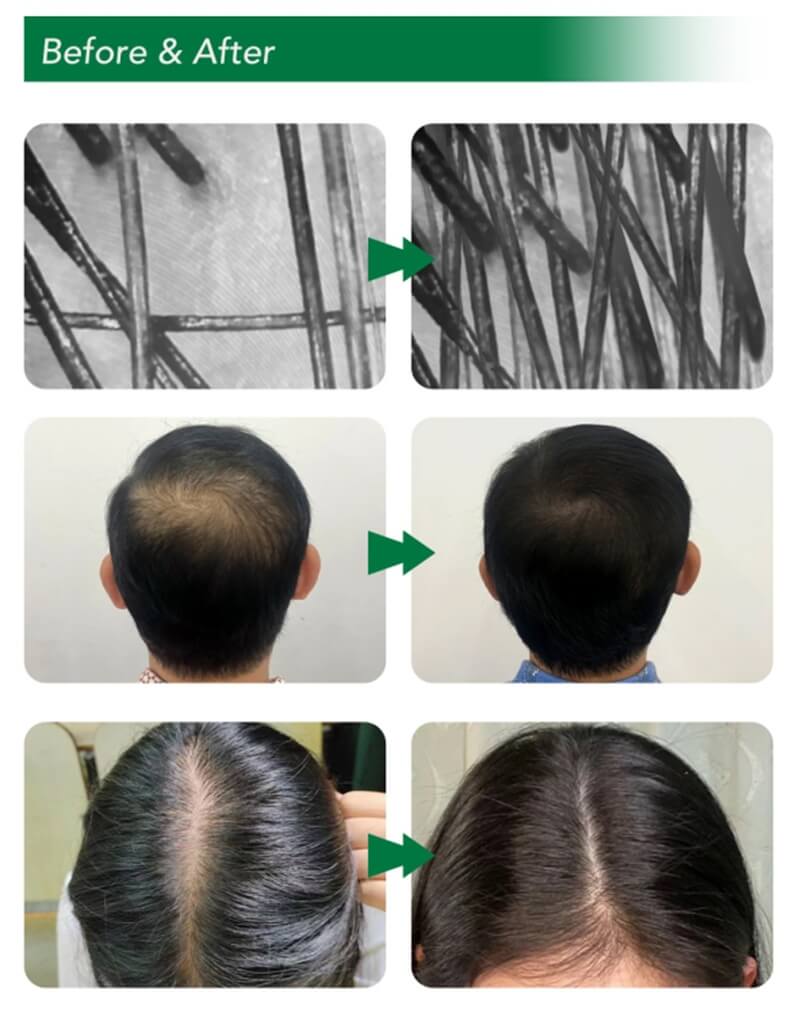 Exosomes for Hair Loss Before and After Results