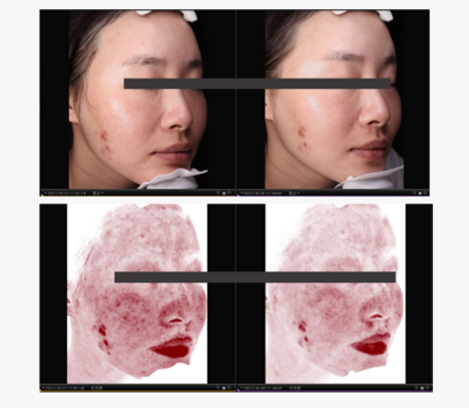Mesocel PDRN serum BEFORE AND AFTER