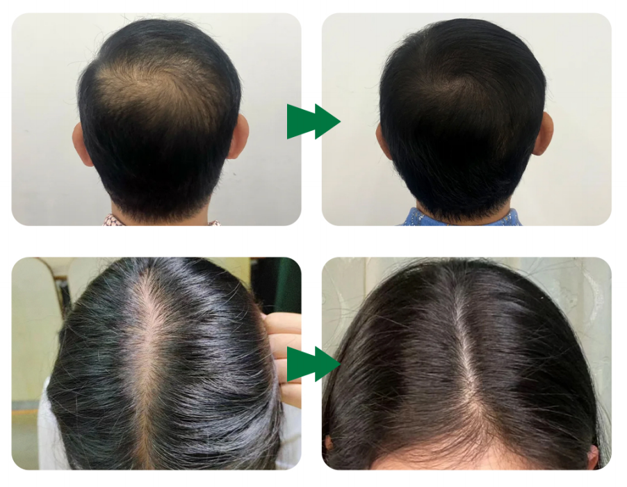 exosome hair therapy before and after