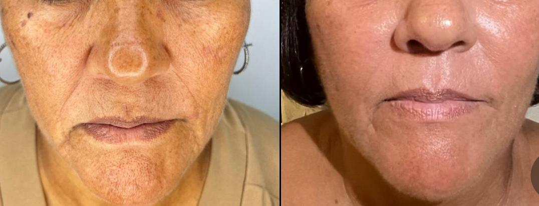 Mesocel PLLA Mesotherapy Solution before after