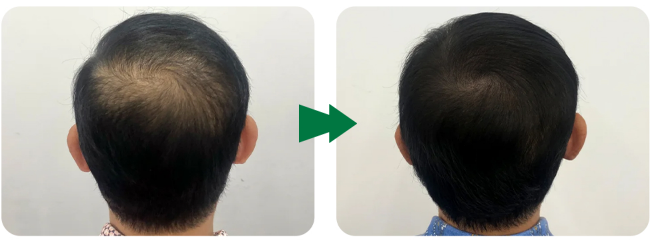 Exosome Injection Before & After&nbsp;
